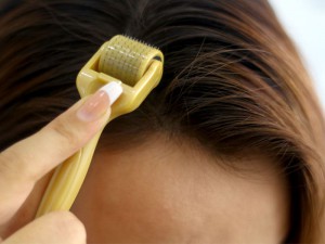 microneedling-treatment-for-hair-loss-min