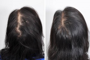 Hair-Restoration-15-PRP