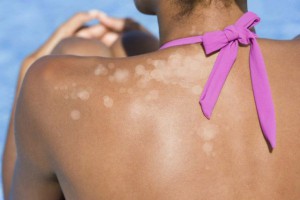 white-spots-from-tanning